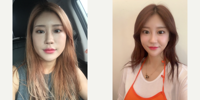 25-34 year old woman treated with Cheekbone Reduction - Facial Contouring 3 Combination (ZAC)
