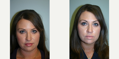 35-44 year old woman treated with Kybella - 35-44 year old woman treated with Kybella