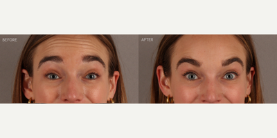 Upper Facial Botox (Forehead, 11's, Crows Feet) - 29-year-old female who requested conservative Botox treatment to address upper facial wrinkles of expression. Conservative dosing was used to preserve facial movement but reduce wrinkling. She is shown two weeks post-treatment.
