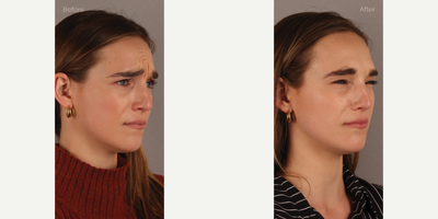 Upper Facial Botox (Forehead, 11's, Crows Feet) - 29-year-old female who requested conservative Botox treatment to address upper facial wrinkles of expression. Conservative dosing was used to preserve facial movement but reduce wrinkling. She is shown two weeks post-treatment.