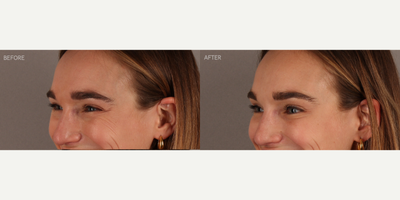 Upper Facial Botox (Forehead, 11's, Crows Feet) - 29-year-old female who requested conservative Botox treatment to address upper facial wrinkles of expression. Conservative dosing was used to preserve facial movement but reduce wrinkling. She is shown two weeks post-treatment.