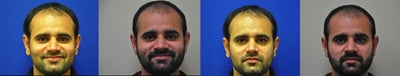 Right Sided Dimple Creation Surgery - This 30 year old male underwent right-sided dimple creation surgery in the office under local anesthesia. The procedure took approximately 30 minutes to perform. He is shown three months following the procedure and is very happy with his new dimple. Many patients opt for dimples in both cheeks (bilateral) whereas others prefer to have one placed on just one side (unilateral).