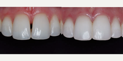 25-34 year old woman treated with Dental Bonding - Patient presented with a small diastema between her central teeth. Due to her shape and size of teeth, bonding was the best option for her to correct. Patient is super happy with results and is now smiling from ear to ear.
