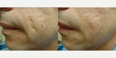 Man treated with Subcision - Subcision for indented scar