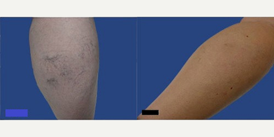 Woman treated with Sclerotherapy - Woman treated with Sclerotherapy