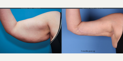 36 year old woman treated with Arm Lift, Embrace Scar Therapy, Liposuction - Full brachioplasty showing 3 months post-op results. Note the scar is still pink and in the process of fading at this point in the recovery.  It takes 1 year for the scars to fully fade.