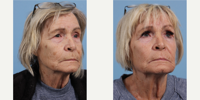 65-74 year old woman treated with Obagi Nu-Derm - 65-74 year old woman treated with Obagi Nu-Derm