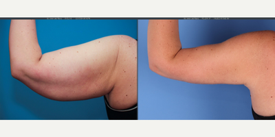 36 year old woman treated with Arm Lift, Embrace Scar Therapy, Liposuction - Full brachioplasty showing 3 months post-op results. Note the scar is still pink and in the process of fading at this point in the recovery.  It takes 1 year for the scars to fully fade.