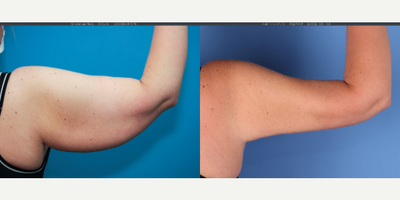 36 year old woman treated with Arm Lift, Embrace Scar Therapy, Liposuction - Full brachioplasty showing 3 months post-op results. Note the scar is still pink and in the process of fading at this point in the recovery.  It takes 1 year for the scars to fully fade.