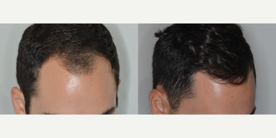 25-34 year old man treated with Hair Transplant, FUE Hair Transplant - Hair Transplant - Male, 27 y/o, 4 yrs post op. 1300 FUE procedure
