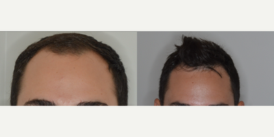25-34 year old man treated with Hair Transplant, FUE Hair Transplant - Hair Transplant - Male, 27 y/o, 4 yrs post op. 1300 FUE procedure
