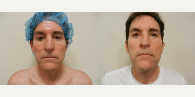 Man treated with Neck Lift - Neck Lift & Fat Transfer (to eyes)