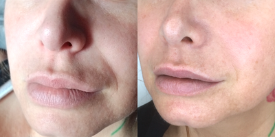 35-44 year old woman treated with Acoustic Wave Therapy - Collagen building and facial conturing, nasolabial fold (smile lines) after a single treatment.