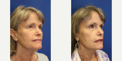 65-74 year old woman treated with TCA Peel - Dr. Katzen used a TCA chemical peel to treat the discoloration of this patient's face.