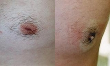 25 year old male patient  - 	Male patient underwent an office procedure for inverted nipples. Post-op photo taken immediately after the half-hour procedure in the office. Note the whitened area around the now everted bud. This will turn normal color within one to hours after the procedures.