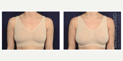 25-34 year old woman treated with Ideal Implant - Breast augmentation. Follow-up photo taken 3 months after the procedure.