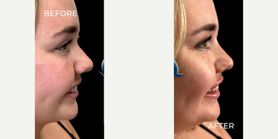 Woman treated with Botox, Lip Fillers - Woman treated with Botox, Lip Fillers