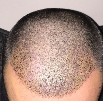 As Hair Transplant Scabs go are these ok? 5 day post op ...