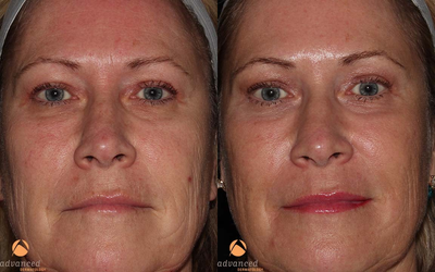 Female Patient Treated for Wrinkles and Texture with C02RE Fractional C02 Resurfacing Treatment - 	3 Months post CO2RE Fractional C02 Resurfacing Treatment