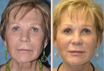 64 Year Old Female Treated for Unacceptable Cosmetic Appearance of Face - 
	Procedure: Facelift

