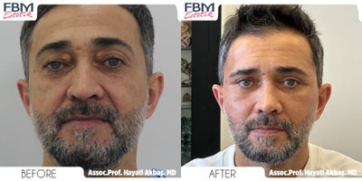 45-54 year old man treated with Deep Plane Facelift, Double Eyelid Surgery, Facial Fat Transfer - .