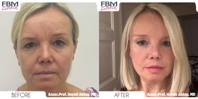 55-64 year old woman treated with Mini Facelift, SMAS Facelift, Mini Neck Lift, Eyelid Surgery - 55-64 year old woman treated with Mini Facelift, SMAS Facelift, Mini Neck Lift, Eyelid Surgery
