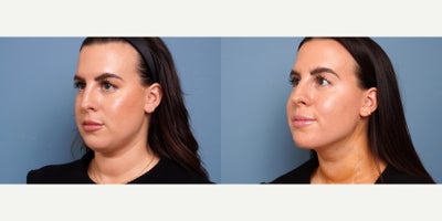 29 year old woman treated with myellevate - 29 year old woman treated with myellevate . Photos depict before and 1 week after surgery