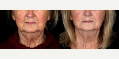 73 year old woman treated with Juvederm, Restylane - 73 year old woman treated with 2 syringes of Juvederm Ultra Plus XC To Nasal Labial Folds and 1 syringe of Restylane to perioral.