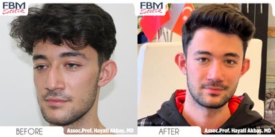 18-24 year old man treated with Rhinoplasty - 18-24 year old man treated with Rhinoplasty