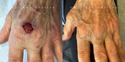 75 and up year old woman treated with Mohs Surgery - 82 years old patient treated with Mohs surgery by Dr. Shelton
