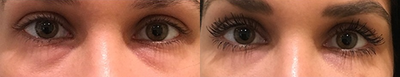 Woman treated with Injectable Fillers - This female patient was treated with Redensity II under her eyes to help reduce the appearance of bags. Her eyes look refreshed and rejuvenated.