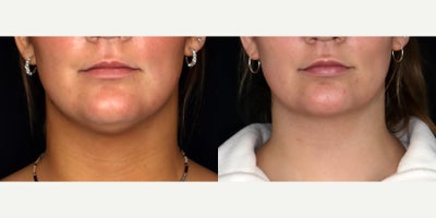 42 year old woman treated with PrecisionTx - 42 year old woman treated with PrecisionTx. Photos depict before and 4 months after surgery.
