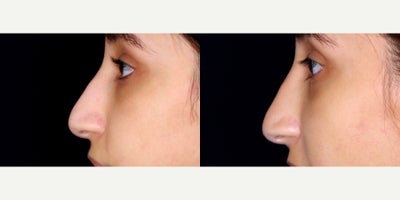 18-24 year old woman treated with Restylane Lyft - 21 year old woman treated with Restylane Lyft. Photos depict before and 1 month after 1 syringe was injected to her nose (liquid rhinoplasty)