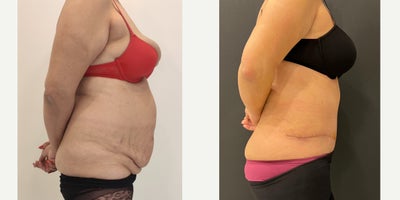 55-64 year old woman treated with Tummy Tuck - tummy tuck surgery with liposuction