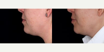 39 year old woman treated with Volbella - 39 year old woman treated with Volbella. Photos depict before and 1 month after 1 syringe of Volbella to lips.