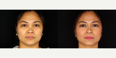 38 year old woman treated with Asian Rhinoplasty - 38 year old woman treated with Asian Rhinoplasty. Photos depict before and 10 months after surgery.
