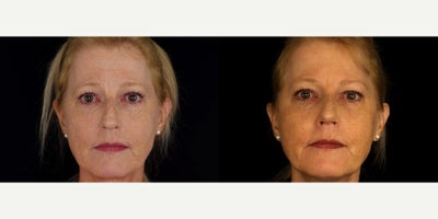 57 year old woman treated with Rhinoplasty, Septoplasty - 57 year old woman treated with Rhinoplasty, Septoplasty. Photos depict before and 1 month after surgery
