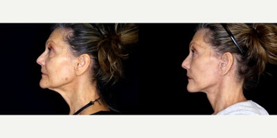 64 year old woman treated with Genioplasty (reduction) and necklift. - 64 year old woman treated with Genioplasty (reduction) and necklift. Photos depict before and 1 month after surgery.