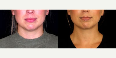 31 year old woman treated with PrecisionTx - 31 year old woman treated with PrecisionTx. Photos depict before and 4.5 months after surgery.