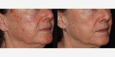45-54 year old woman treated with Laser Genesis, Laser Resurfacing, Excel V - Patient was treated with laser treatments to clear up skin and treat rosacea / redness.
