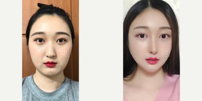 25-34 year old woman treated with Cheekbone Reduction, Jaw Reduction, Double Eyelid Surgery, Asian Rhinoplasty - Open- RhinoplastyCheekbone ReductionSquare Jawline ReductionNon-incisional Double Eyelid Surgery (Revision)