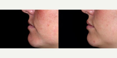 29year old woman treated with Volbella - 29year old woman treated with Volbella, Lip Fillers. Photos depict before and 2 weeks after treatment.