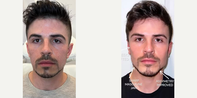 Man treated with Facial - Man treated with Facial