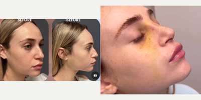 18-24 year old woman treated with Rhinoplasty - Rhinoplasty reveal: Our patient is one week post-op rhinoplasty! 