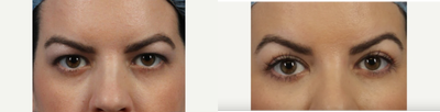 1 year after upper eyelid lift (blepharoplasty) surgery - Upper eyelid lift surgery was performed to define the upper eyelid shape.
