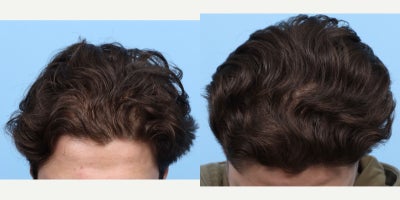 18-24 year old man treated with PRP Injections, PRP for Hair Loss - Prior to PRP hair loss treatment, this 21-year-old patient experienced significant hair thinning, visible scalp, and sparse follicles in certain areas. After three PRP sessions with Dr. Wise, he showed remarkable improvements, including enhanced hair density, thicker strands, reduced scalp visibility, and a fuller look, with noticeable regrowth in the previously thinning areas.