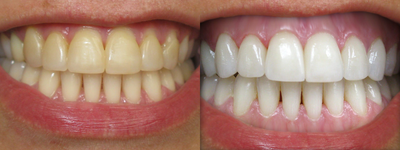 Teeth Whitening & Veneers Before & After Photo - 
	Patient had BriteSmile teeth whitening and veneers placed on the upper anterior teeth.
