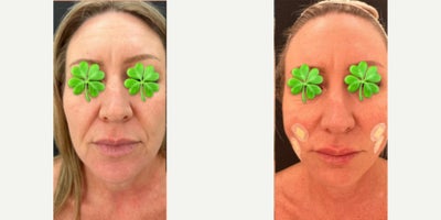 55-64 year old woman treated with Thread Lift - Thread lift application for middle and lower face. The after photo shows the improvement of nasolabial and marionette lines. This photo has taken right after the application.