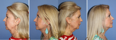  Neck lift  - Neck lift and lower face lift with local anesthesia and twilight sedation without the need for general anesthesia.