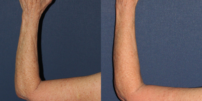 63 year old woman treated with IPL and q-switched alex laser - This 63 year old woman was treated by Dr. Groff one time with IPL and a q-switched alex laser. Notice significant decrease in sun damage and brown spots in one treatment.